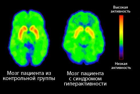 Синдром моторной дисфазии